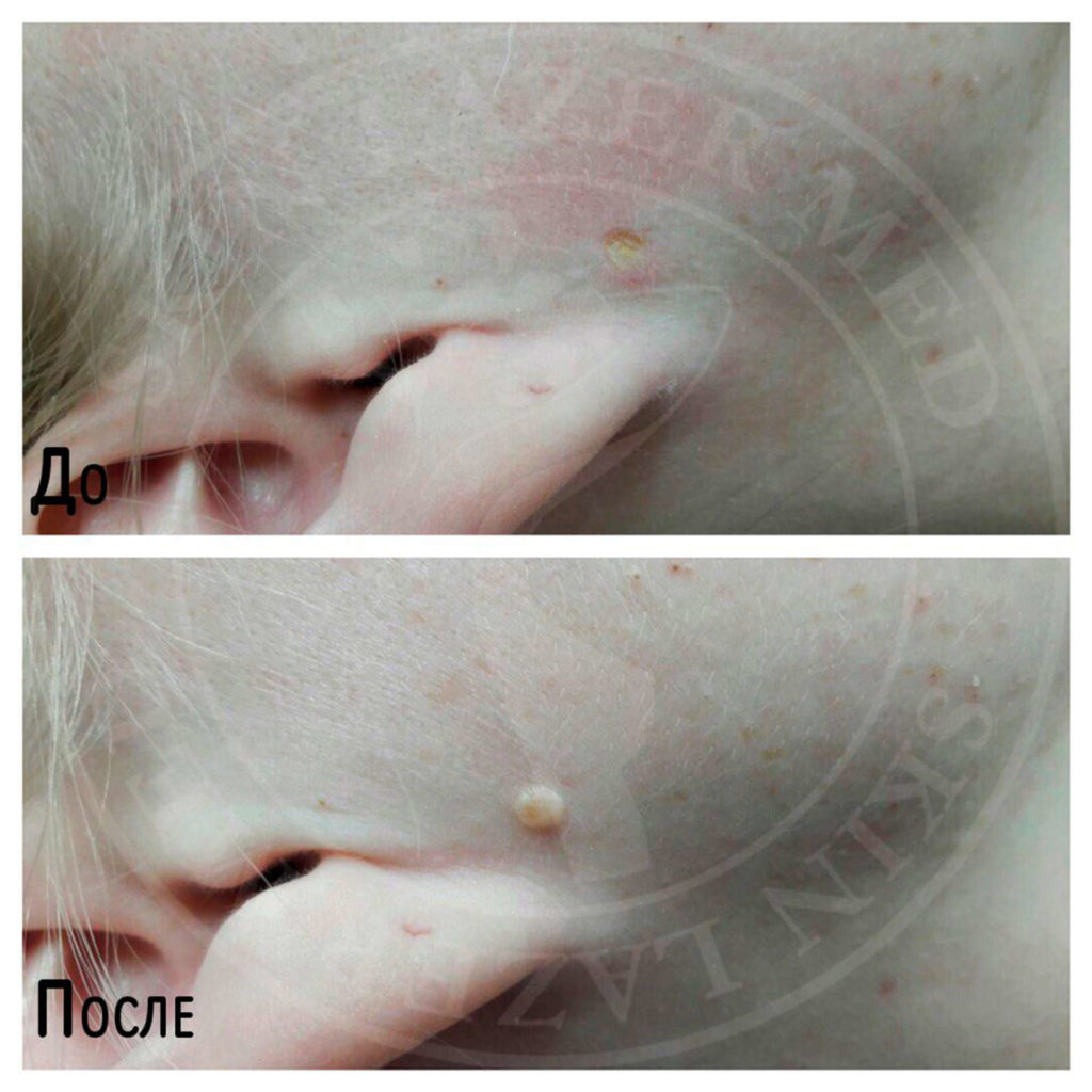 удаление фибромы кожи